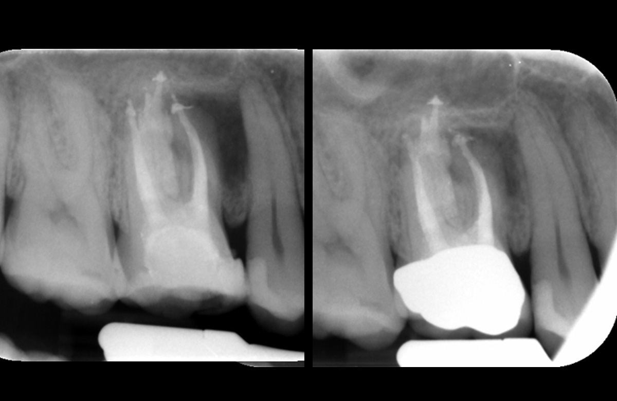 Orthograde Root Canal Retreatment Case Study-4