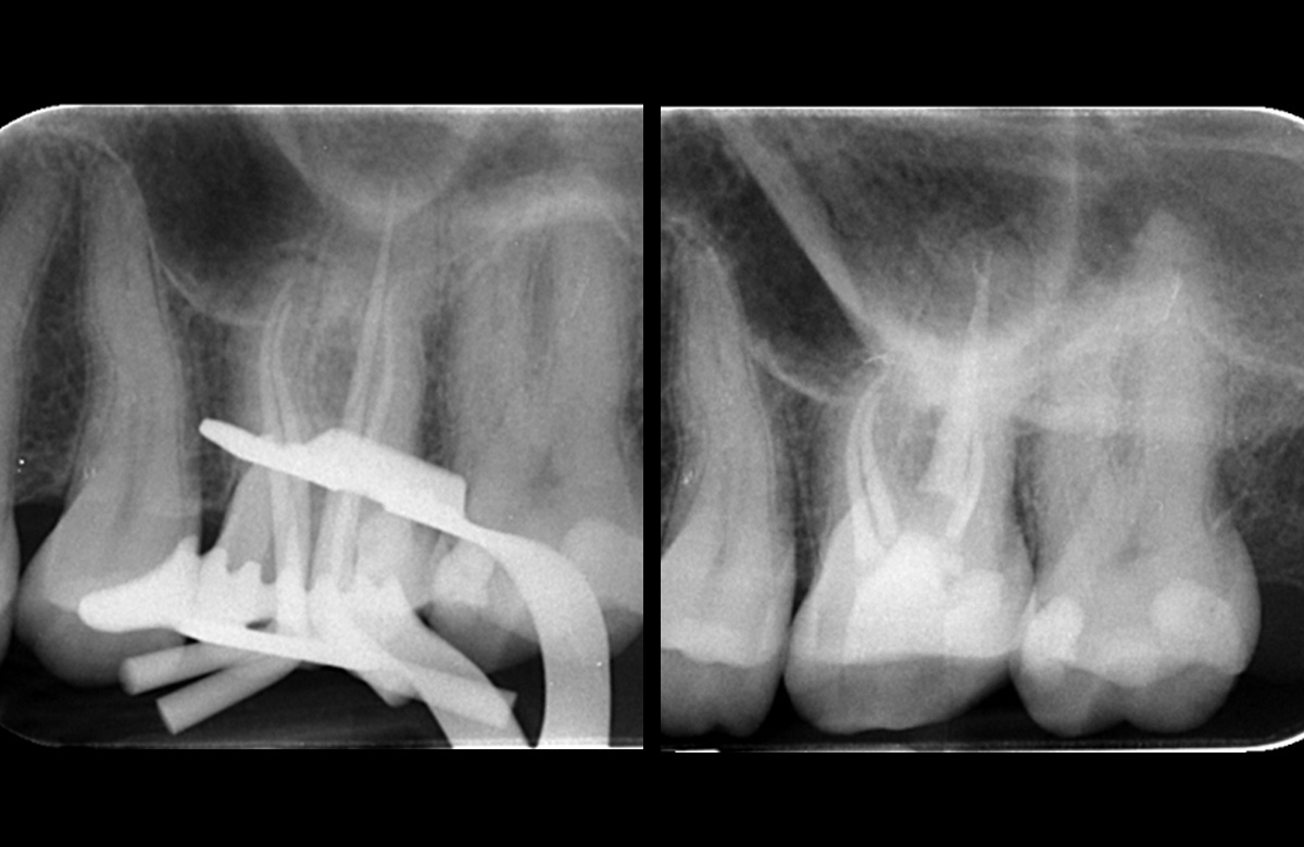 Orthograde Root Canal Treatment Case Study-3