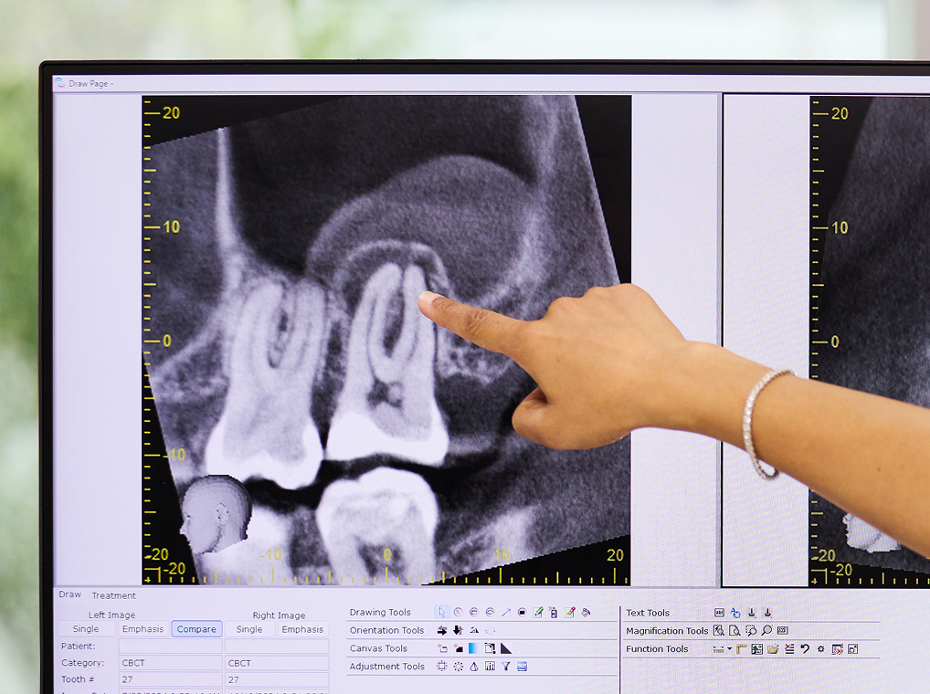 Dental x-ray of tooth | Endodontist Clinic Sydney