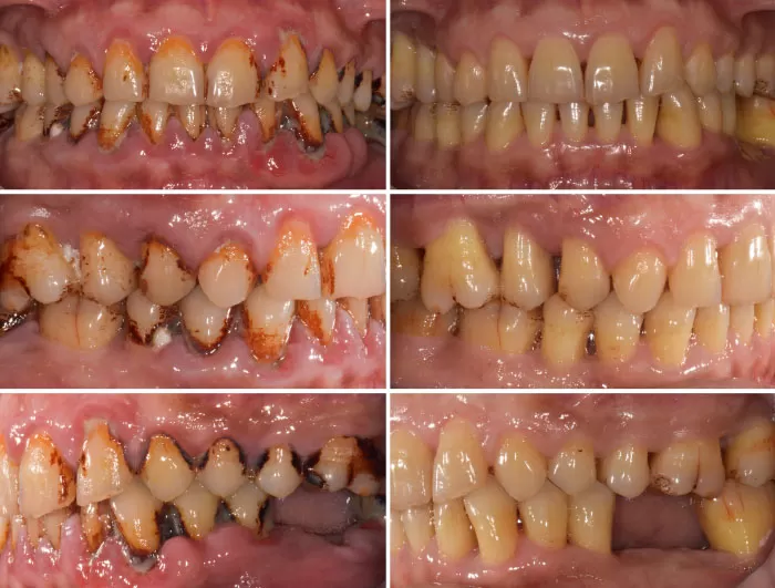 Generalised Moderate-Advanced Chronic Periodontitis