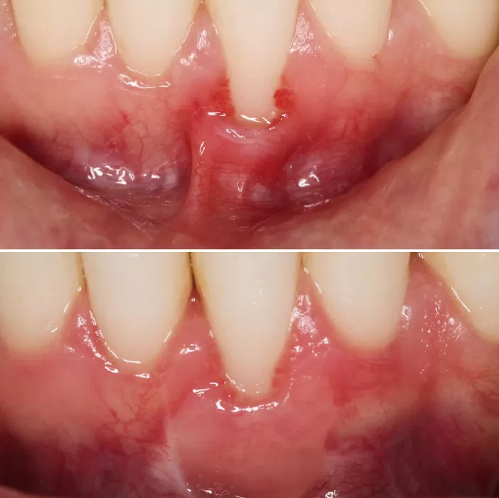 Gingival Recession of Lower Incisor