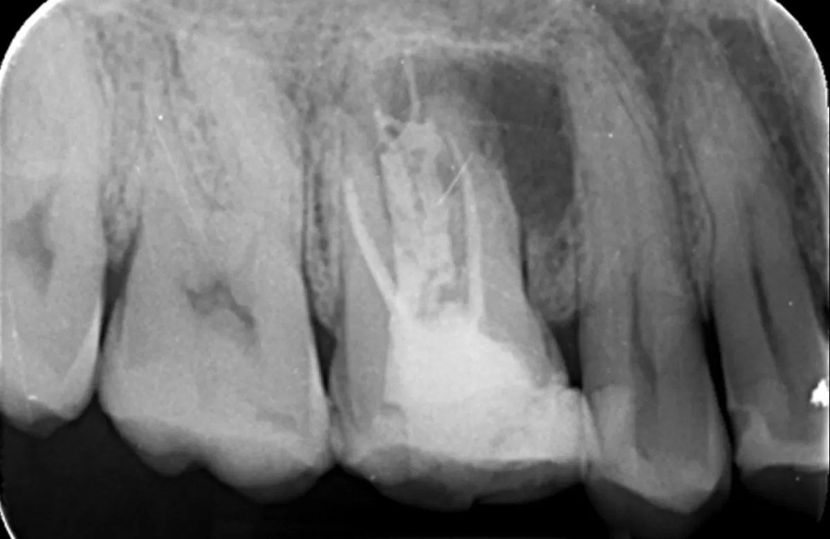 Orthograde Root Canal Retreatment Case Study-1