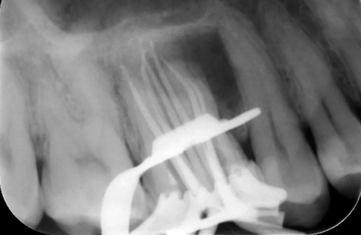 Orthograde Root Canal Retreatment Case Study-3