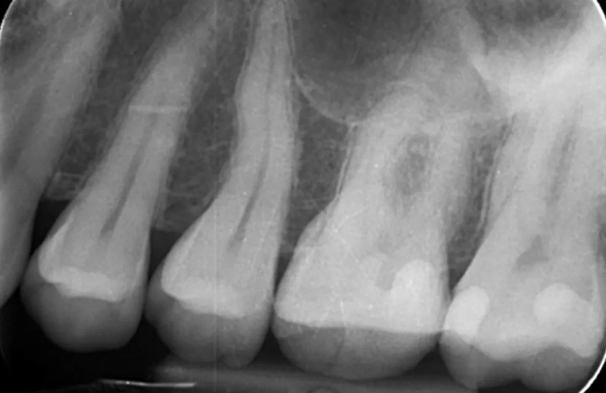 Orthograde Root Canal Treatment Case Study-1